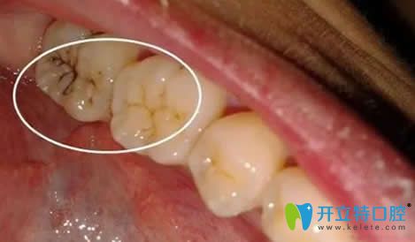 窩溝封閉前的牙齒