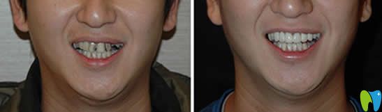 湛江致美口腔全瓷冠牙齒美容效果