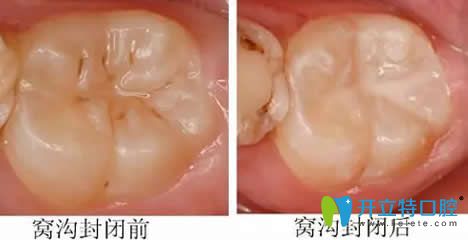 窩溝封閉前后對(duì)比圖