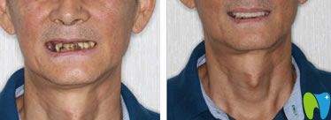 抽煙者戒煙后的種植牙效果