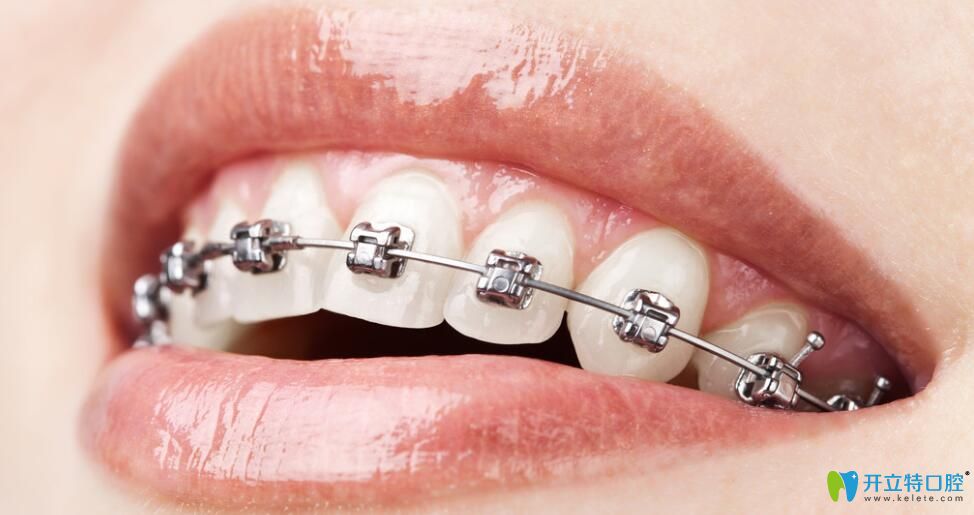 老姐問我唇側(cè)和舌側(cè)矯正哪個好&價格是多少