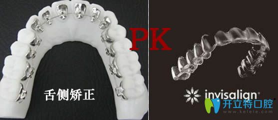 隱適美矯正和舌側(cè)矯正哪個好