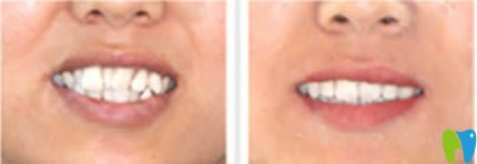 西安諾貝爾趙虎醫(yī)生成年人牙齒畸形擁擠矯正對(duì)比效果