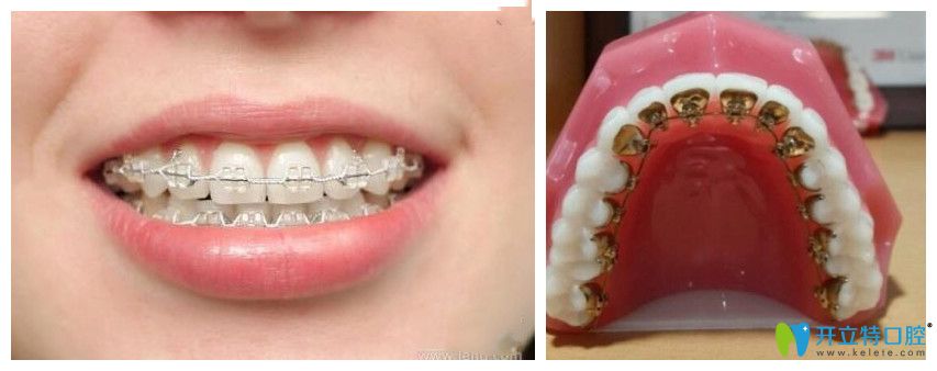 唇側(cè)矯正和舌側(cè)矯正哪個好呢