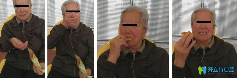 那彤全口義齒修復(fù)病例 那彤全口義齒修復(fù)病例