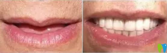 西安諾貝爾口腔李江院長60歲老人全口種植牙前后對(duì)比<span style=