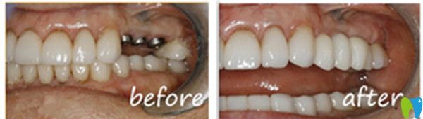 吉林愛齒口腔種植牙前后對比圖