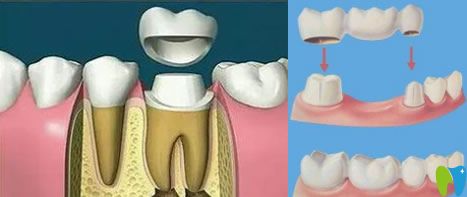 臨時牙冠能戴多久,掉了怎么辦？