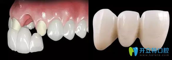 臨時牙冠掉了怎么辦