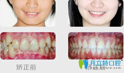 南京博韻許辰林26歲顧客虎牙矯正案例及臉型變化圖