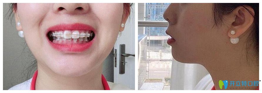 格倫菲爾口腔體驗半隱形冰晶托槽矯正4個月效果圖