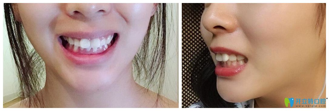 在格倫菲爾口腔體驗半隱形冰晶托槽矯正