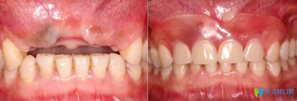 西安中諾蘇醫(yī)生上頜牙多顆缺失修復(fù)前后對(duì)比照
