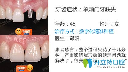 南京博韻口腔鄭陽單顆種植效果