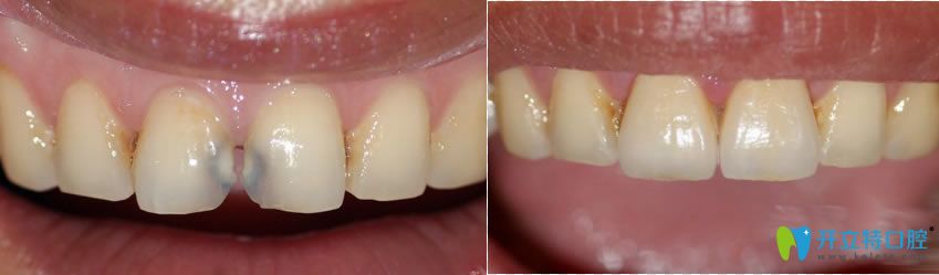 西安中諾蘇雪梅前門(mén)牙齒修復(fù)前后對(duì)比效果