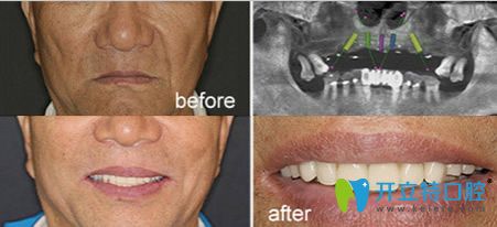 南京博韻口腔種植牙案例