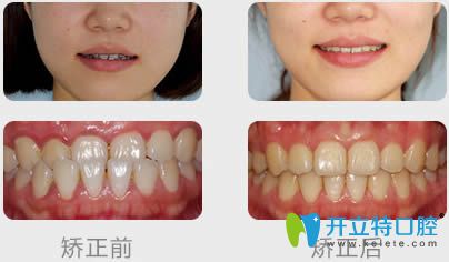 南京博韻許醫(yī)生青少年地包天矯正案例及臉型變化