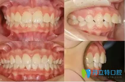 西安中諾口腔孫麗35歲顧客齙牙矯正案例及前后對(duì)比效果