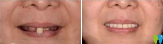 西安中諾劉世恒醫(yī)生立得用種植牙前后對(duì)比效果