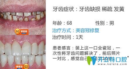 南京博韻口腔周光正靠譜嗎？美容冠修復(fù)案例公布