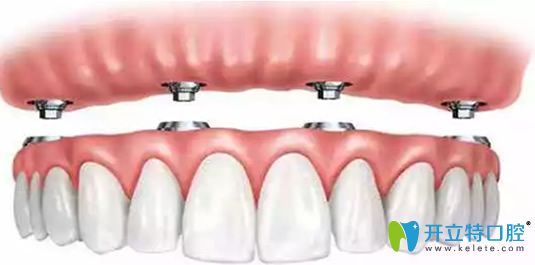 all on 4全口種植牙
