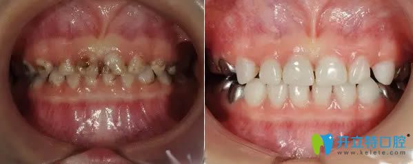 西安中諾口腔兒童齲齒治療前后對(duì)比照