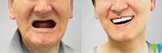 全口種植牙前后對比圖