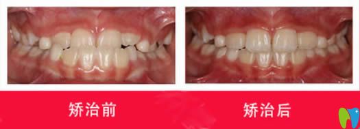 西安中諾口腔張孜兒童地包天選擇MRC肌功能矯正前后對(duì)比效果