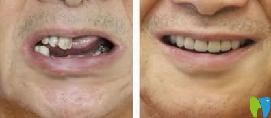 中山好民生口腔黎洪強醫(yī)生多顆牙種植效果 中山好民生口腔黎洪強醫(yī)生多顆牙種植效果