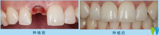 中山好民生口腔單顆種植牙案例