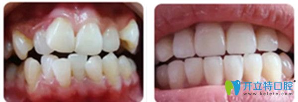 吉林愛齒口腔牙齒矯正對(duì)比圖