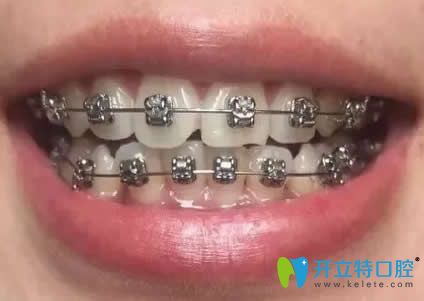 我在昆明王巍口腔矯正戴牙套第9個(gè)月