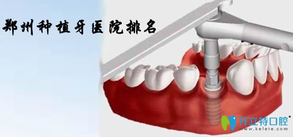 通過(guò)鄭州種植牙醫(yī)院排名及價(jià)格揭曉鄭州種植牙哪家醫(yī)院好
