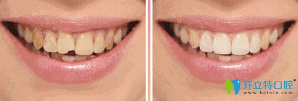 輕度牙齒缺損修復(fù)后對(duì)比照