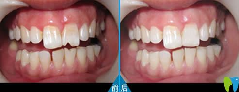 門牙磨損貼面修復(fù)效果