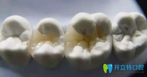 后牙磨損修復(fù)方法