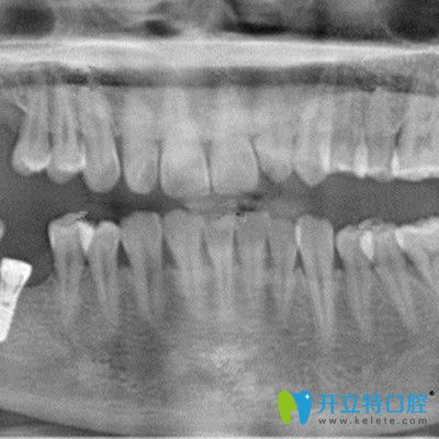 在吉林愛齒口腔做即刻種植牙拍片照片