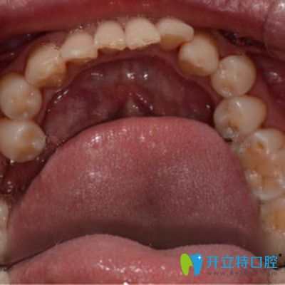 牙齒缺失前的照片