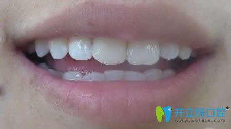 我在淄博海全口腔做牙齒瓷貼面修復(fù)后照片 我在淄博海全口腔做牙齒瓷貼面修復(fù)后照片