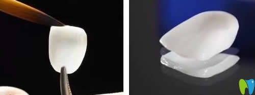 我在淄博海全口腔做超薄瓷貼面修復(fù) 我在淄博海全口腔做超薄瓷貼面修復(fù)