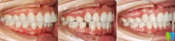 隱形牙齒矯正治療前后變化圖