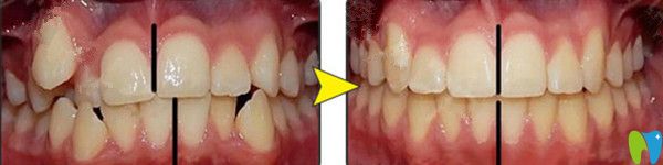 金屬托槽矯正前后對(duì)比圖