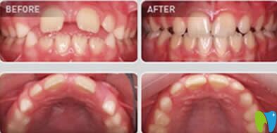 南昌安植雅口腔黃奇卿醫(yī)生兒童牙齒矯正案例