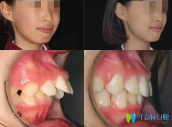 12歲青少年深覆蓋矯正后臉型變化