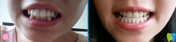 牙齒矯正前后對比圖 牙齒矯正前后對比圖