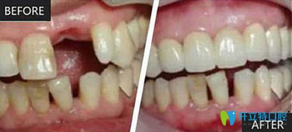 即刻種植前后變化圖 即刻種植前后變化圖