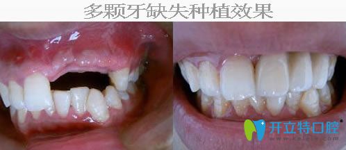 多顆牙缺失種植修復效果