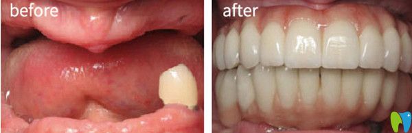 泰州北極星口腔怎么樣？看全口種植牙案例