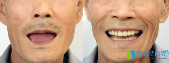 泉州維樂(lè)謝燕峰醫(yī)生3D數(shù)字導(dǎo)板全口種植牙對(duì)比效果