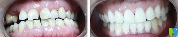 前牙縫過大修復后效果圖